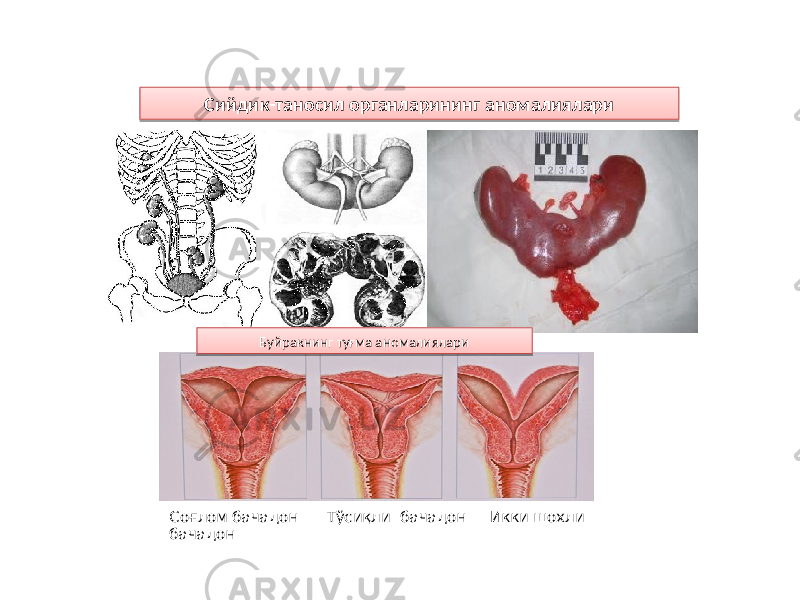 Соғлом бачадон Тўсиқли бачадон Икки шохли бачадон Сийдик-таносил органларининг аномалиялари Буйракнинг туғма аномалиялари42 32 