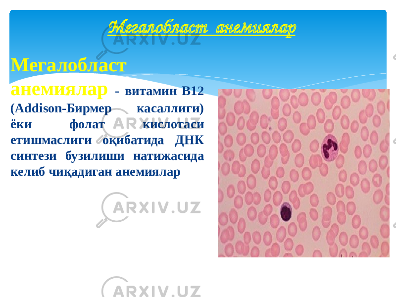 Мегалобласт анемиялар - витамин В12 (Addison-Бирмер касаллиги) ёки фолат кислотаси етишмаслиги оқибатида ДНК синтези бузилиши натижасида келиб чиқадиган анемиялар Мегалобласт анемиялар 