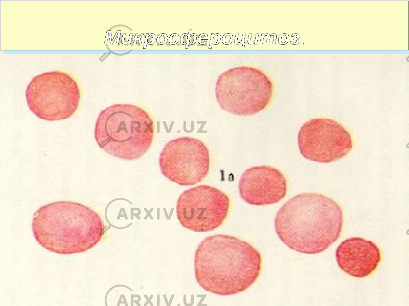 Микросфероцитоз.Микросфероцитоз. 