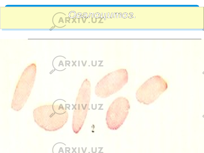  Овалоцитоз.Овалоцитоз. 