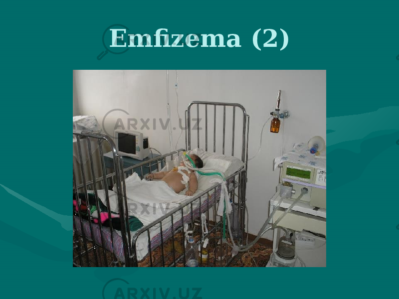 Emfizema (2) 