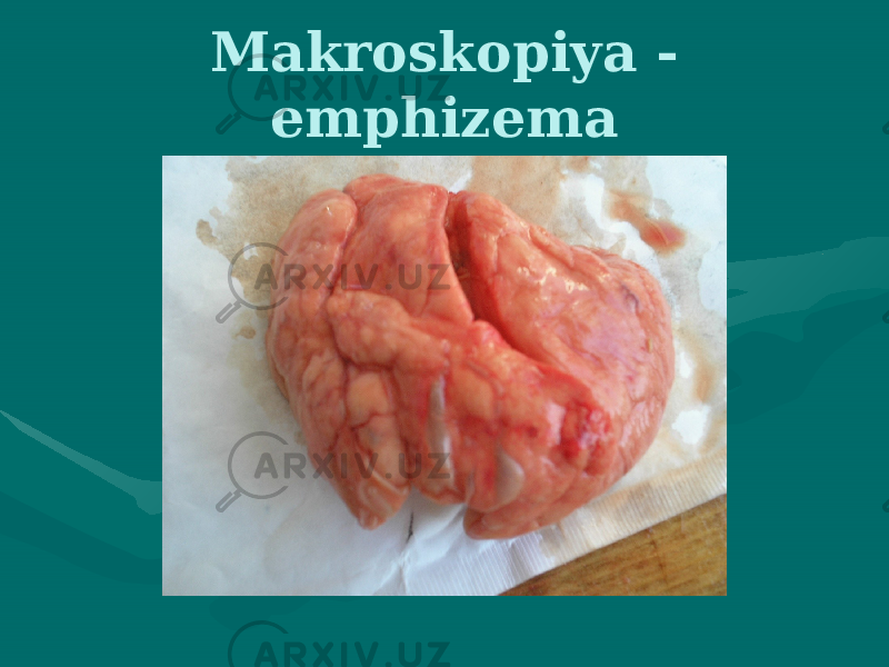 Makroskopiya - emphizema 