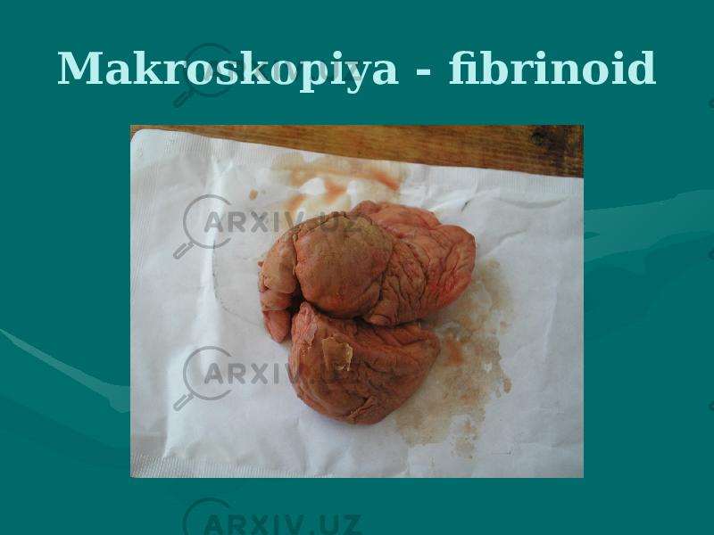 Makroskopiya - fibrinoid 