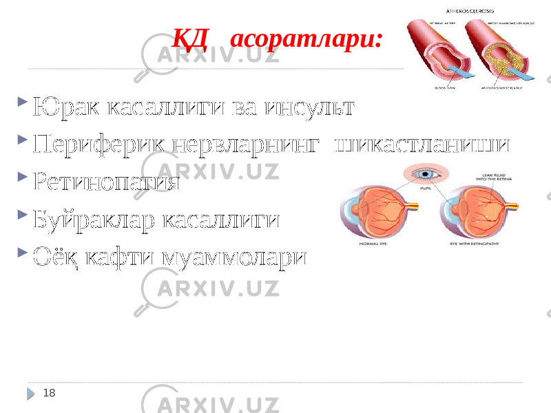 ҚД асоратлари:  Юрак касаллиги ва инсульт  Периферик нервларнинг шикастланиши  Ретинопатия  Буйраклар касаллиги  Оёқ кафти муаммолари 18 