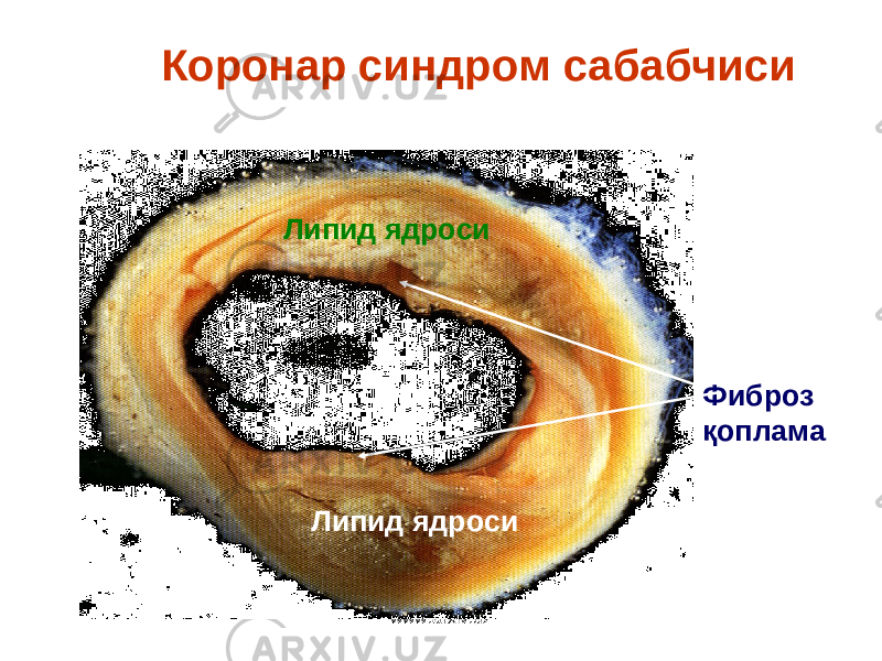 Липид ядро си Липид ядро си Фиброз қопламаК оронар синдром сабабчиси www.arxiv.uz 