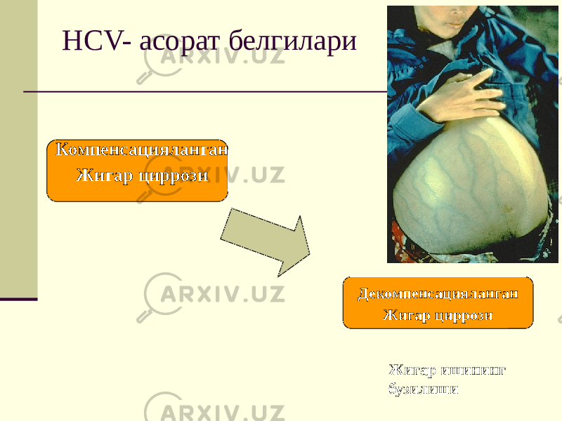 HCV- асорат белгилари Компенсацияланган Жигар циррози Декомпенсацияланган Жигар циррози Жигар ишининг бузилиши 