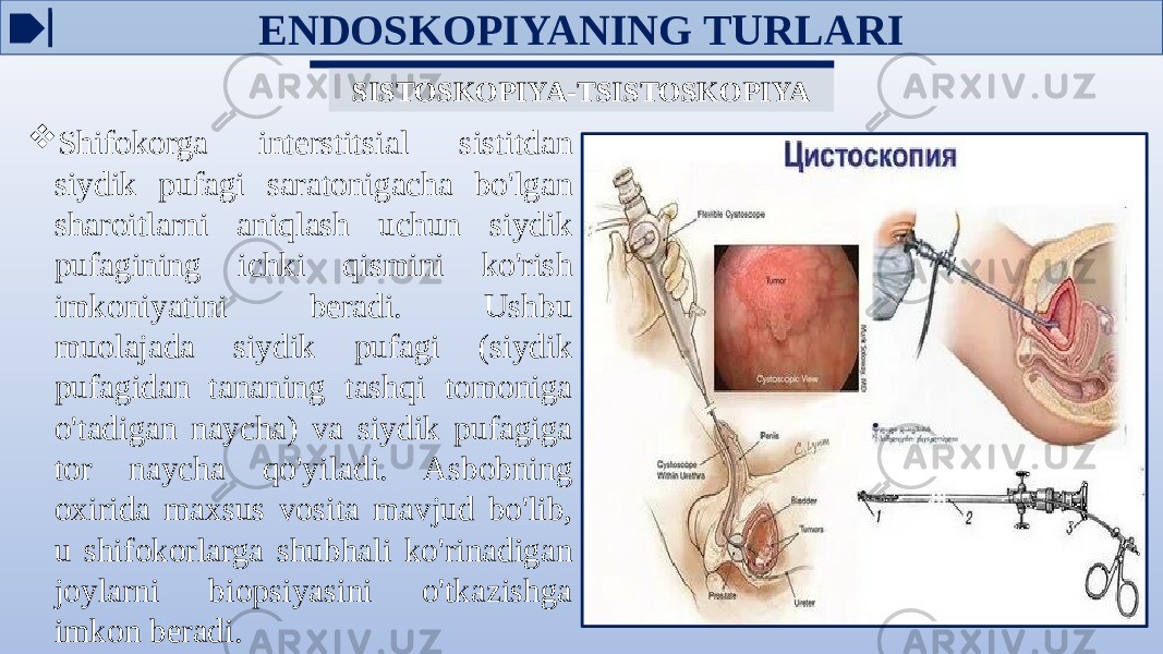 SISTOSKOPIYA-TSISTOSKOPIYA  Shifokorga interstitsial sistitdan siydik pufagi saratonigacha bo&#39;lgan sharoitlarni aniqlash uchun siydik pufagining ichki qismini ko&#39;rish imkoniyatini beradi. Ushbu muolajada siydik pufagi (siydik pufagidan tananing tashqi tomoniga o&#39;tadigan naycha) va siydik pufagiga tor naycha qo&#39;yiladi. Asbobning oxirida maxsus vosita mavjud bo&#39;lib, u shifokorlarga shubhali ko&#39;rinadigan joylarni biopsiyasini o&#39;tkazishga imkon beradi. ENDOSKOPIYANING TURLARI 