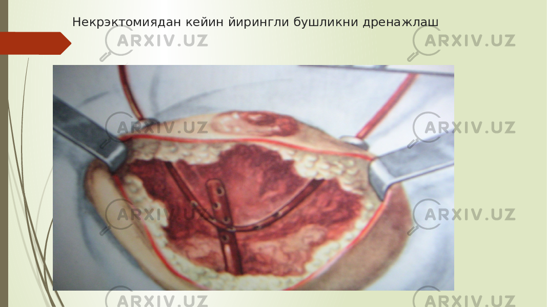 Некрэктомиядан кейин йирингли бушликни дренажлаш 