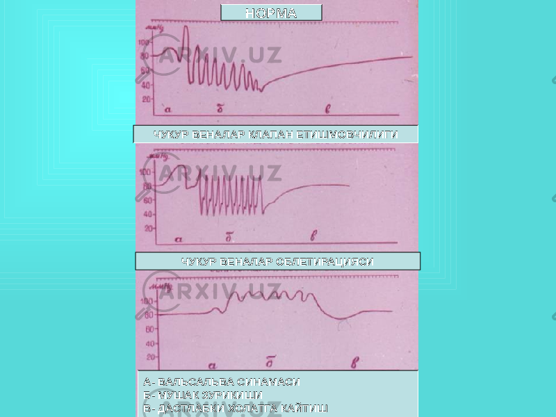 НОРМА ЧУКУР ВЕНАЛАР КЛАПАН ЕТИШМОВЧИЛИГИ ЧУКУР ВЕНАЛАР ОБЛЕТИРАЦИЯСИ А- ВАЛЬСАЛЬВА СИНАМАСИ Б- МУШАК ЗУРИКИШИ В- ДАСТЛАБКИ ХОЛАТГА КАЙТИШ 