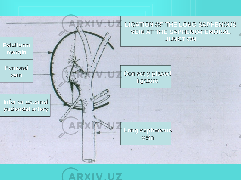 LIGATION OF THE LONG SAPHENOUS VEIN AT THE SAPHENO-FEMORAL JUNCTION Falciform margin Femoral vein Inferior external pudendal artery Correctly placed ligature Long saphenous vein 