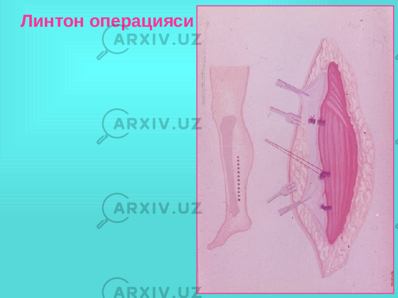  Линтон операцияси 