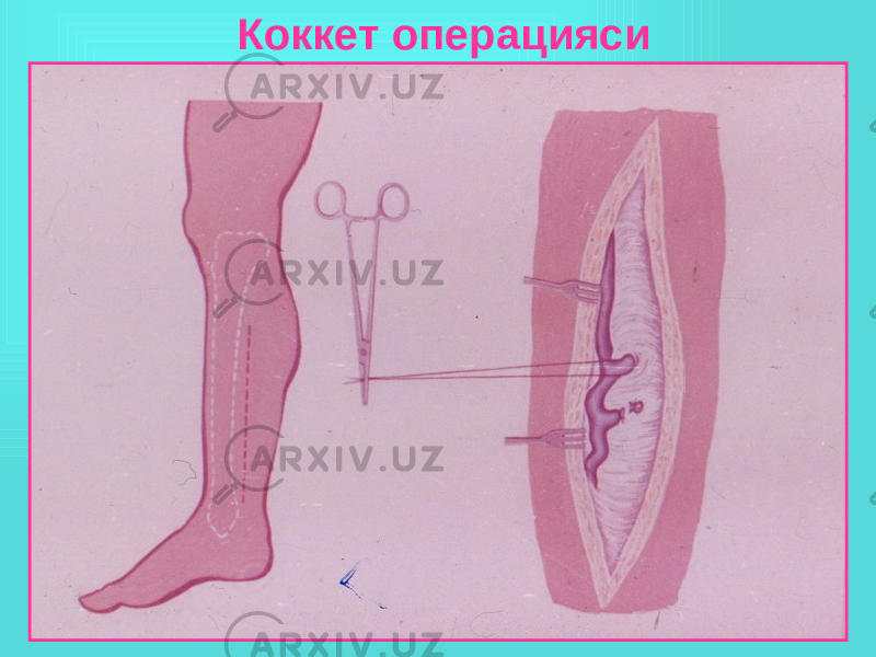 Коккет операцияси 