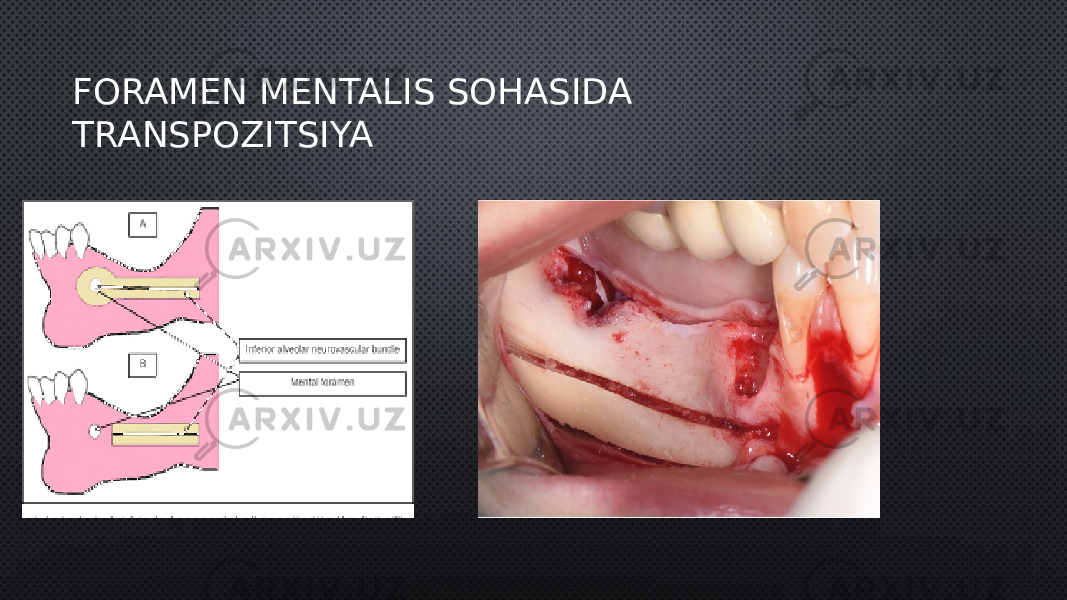 FORAMEN MENTALIS SOHASIDA TRANSPOZITSIYA 