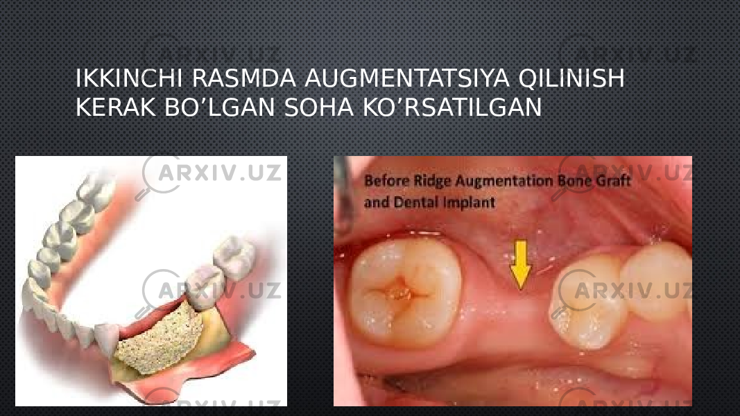 IKKINCHI RASMDA AUGMENTATSIYA QILINISH KERAK BO’LGAN SOHA KO’RSATILGAN 