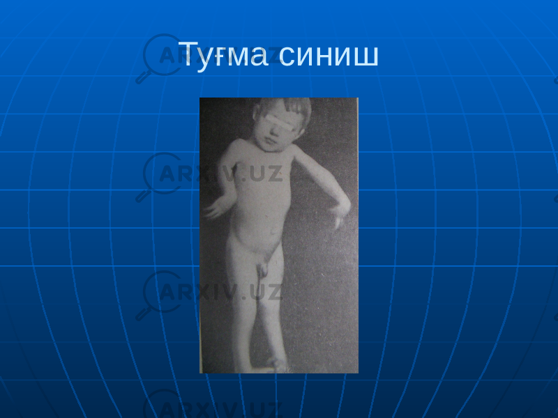 Туғма синиш 