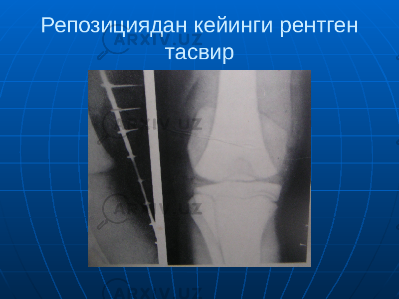 Репозициядан кейинги рентген тасвир 