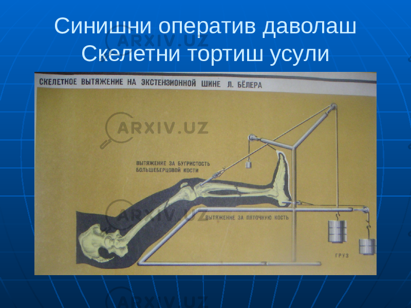 Синишни оператив даволаш Скелетни тортиш усули 