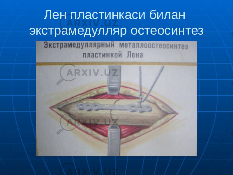 Лен пластинкаси билан экстрамедулляр остеосинтез 