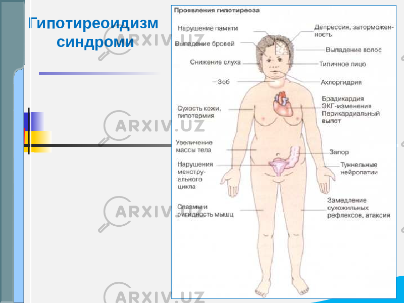 Гипотиреоидизм синдроми 