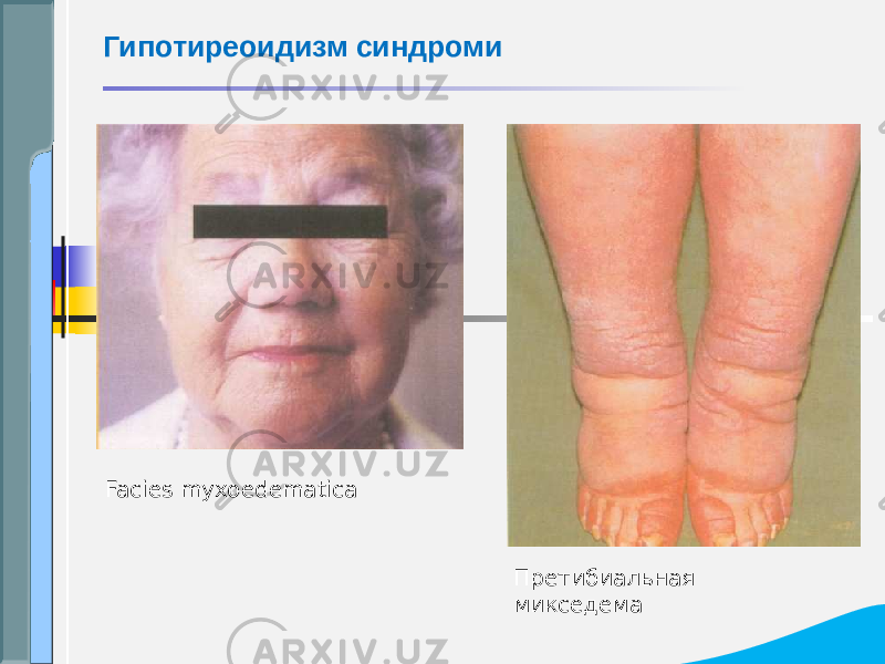 Гипотиреоидизм синдроми Facies myxoedematica Претибиальная микседема 