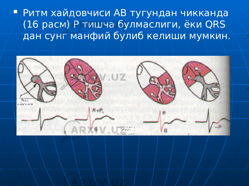  Ритм хайдовчиси АВ тугундан чикканда (16 расм) Р тишча булмаслиги, ёки QRS дан сунг манфий булиб келиши мумкин. 