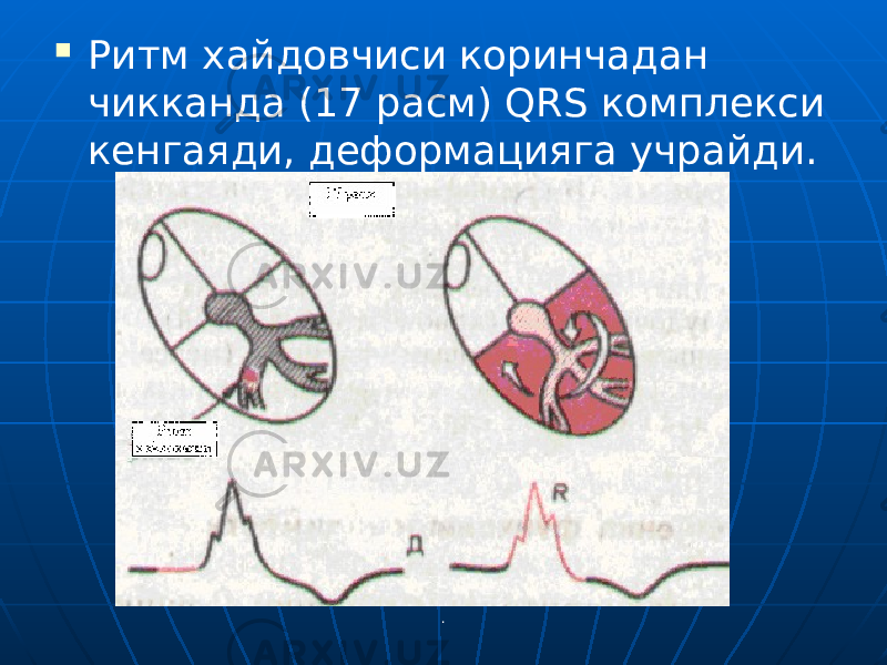 . Ритм хайдовчиси коринчадан чикканда (17 расм) QRS комплекси кенгаяди, деформацияга учрайди. 