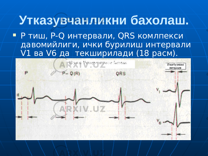 Утказувчанликни бахолаш.  P тиш, P-Q интервали, QRS комлпекси давомийлиги, ички бурилиш интервали V1 ва V6 да текширилади (18 расм). 