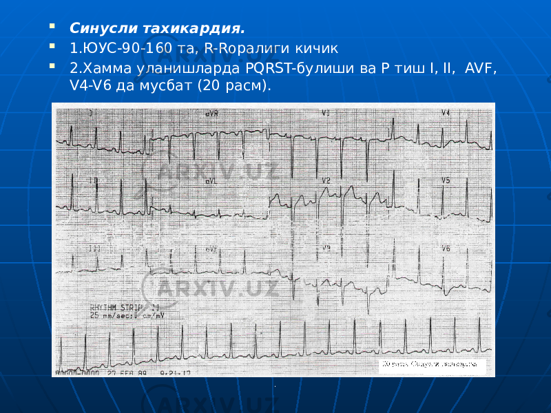 . Синусли тахикардия.  1.ЮУС-90-160 та, R-Rоралиги кичик  2.Хамма уланишларда PQRST-булиши ва Р тиш I, II, AVF, V4-V6 да мусбат (20 расм). 