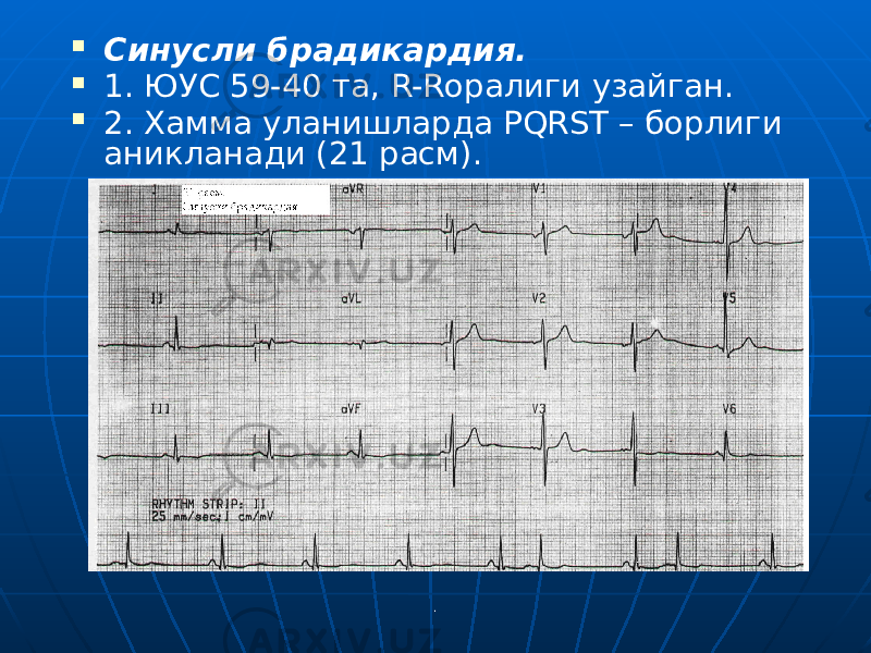 . Синусли брадикардия.  1. ЮУС 59-40 та, R-Rоралиги узайган.  2. Хамма уланишларда PQRST – борлиги аникланади (21 расм). 