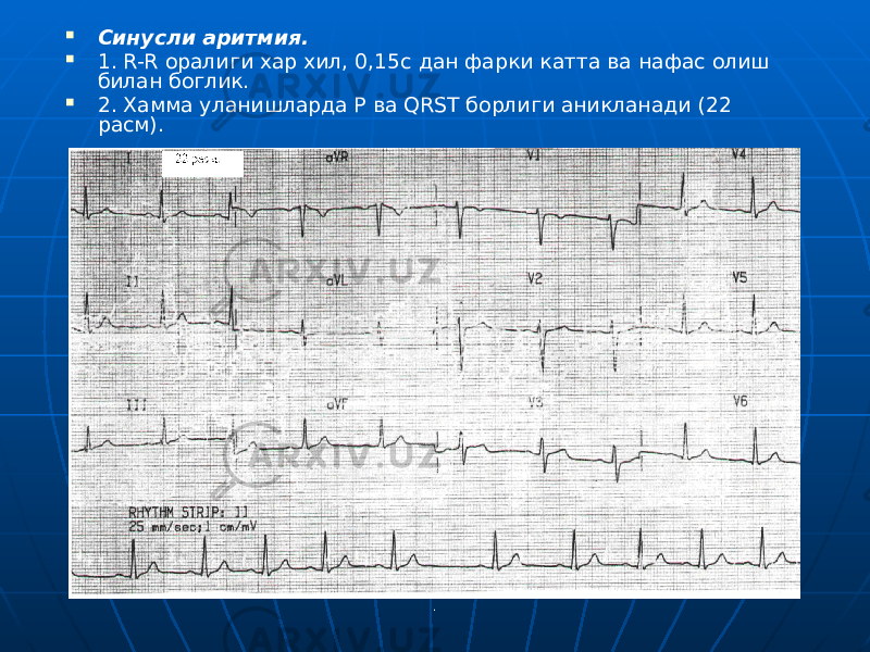 . Синусли аритмия.  1. R-R оралиги хар хил, 0,15с дан фарки катта ва нафас олиш билан боглик.  2. Хамма уланишларда P ва QRST борлиги аникланади (22 расм). 