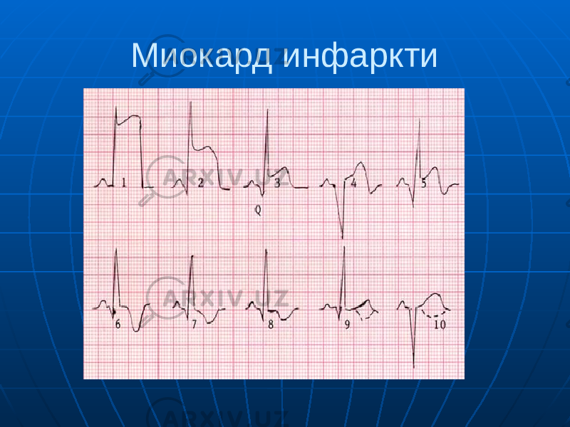 Миокард инфаркти 