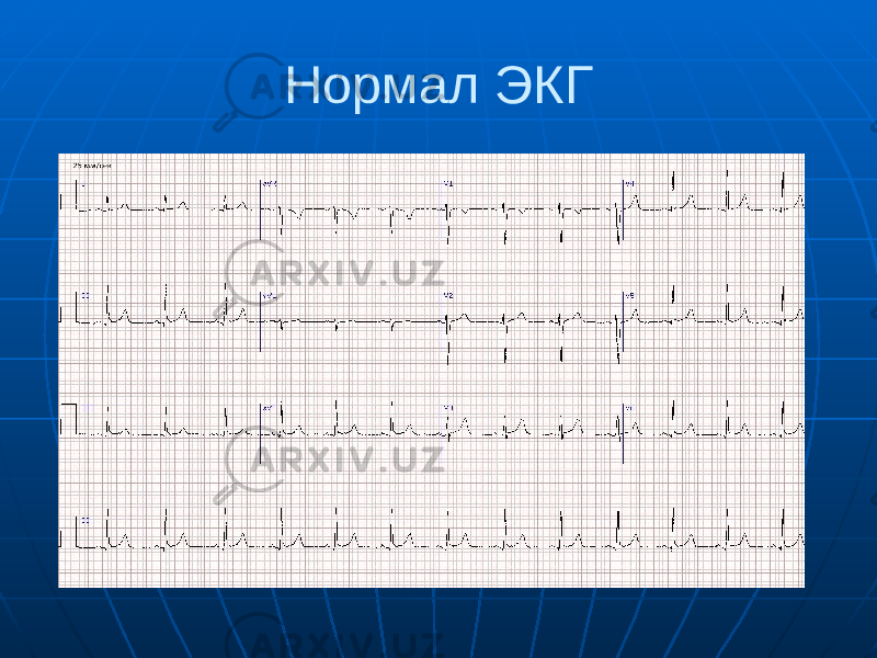 Нормал ЭКГ 