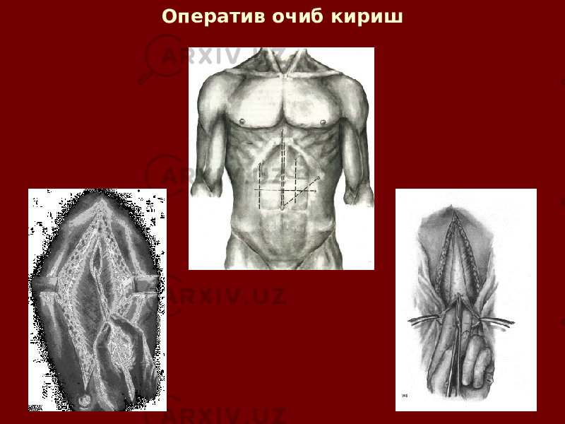 Оператив очиб кириш 