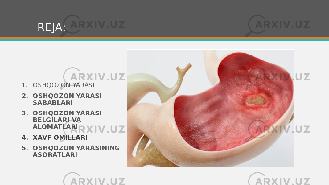REJA: 1. OSHQOZON YARASI 2. OSHQOZON YARASI SABABLARI 3. OSHQOZON YARASI BELGILARI VA ALOMATLARI 4. XAVF OMILLARI 5. OSHQOZON YARASINING ASORATLARI 