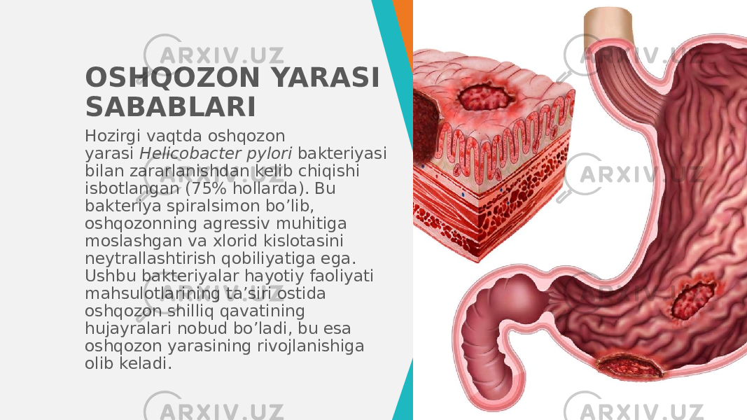 OSHQOZON YARASI SABABLARI Hozirgi vaqtda oshqozon yarasi  Helicobacter pylori  bakteriyasi bilan zararlanishdan kelib chiqishi isbotlangan (75% hollarda). Bu bakteriya spiralsimon bo’lib, oshqozonning agressiv muhitiga moslashgan va xlorid kislotasini neytrallashtirish qobiliyatiga ega. Ushbu bakteriyalar hayotiy faoliyati mahsulotlarining ta’siri ostida oshqozon shilliq qavatining hujayralari nobud bo’ladi, bu esa oshqozon yarasining rivojlanishiga olib keladi. 