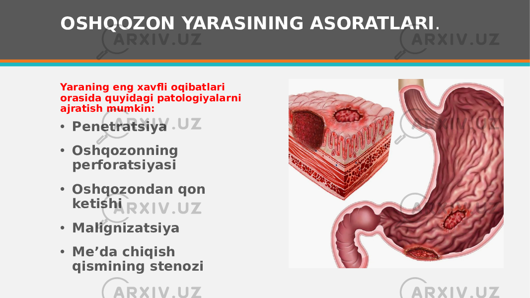 OSHQOZON YARASINING ASORATLARI . Yaraning eng xavfli oqibatlari orasida quyidagi patologiyalarni ajratish mumkin: • Penetratsiya • Oshqozonning perforatsiyasi • Oshqozondan qon ketishi • Malignizatsiya • Me’da chiqish qismining stenozi 