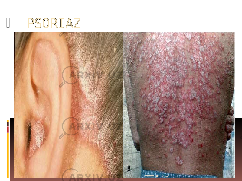 PSORIAZ www.arxiv.uz 