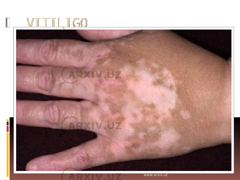 VITILIGO www.arxiv.uz 