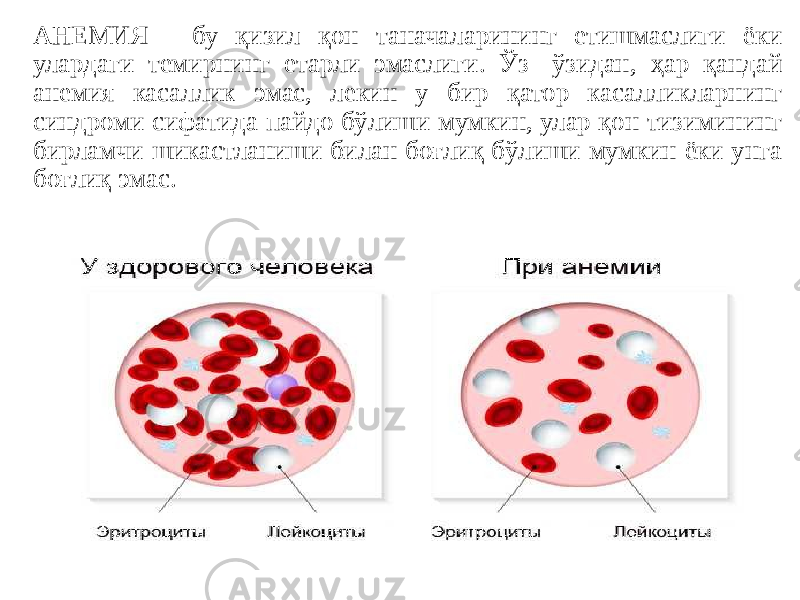 АНЕМИЯ - бу қизил қон таначаларининг етишмаслиги ёки улардаги темирнинг етарли эмаслиги. Ўз -ўзидан, ҳар қандай анемия касаллик эмас, лекин у бир қатор касалликларнинг синдроми сифатида пайдо бўлиши мумкин, улар қон тизимининг бирламчи шикастланиши билан боғлиқ бўлиши мумкин ёки унга боғлиқ эмас. 