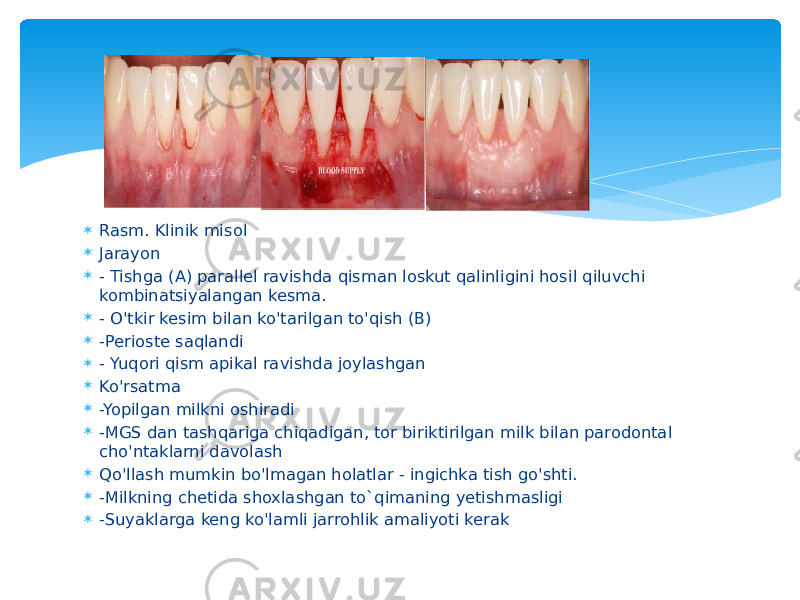  Rasm. Klinik misol  Jarayon  - Tishga (A) parallel ravishda qisman loskut qalinligini hosil qiluvchi kombinatsiyalangan kesma.  - O&#39;tkir kesim bilan ko&#39;tarilgan to&#39;qish (B)  -Perioste saqlandi  - Yuqori qism apikal ravishda joylashgan  Ko&#39;rsatma  -Yopilgan milkni oshiradi  -MGS dan tashqariga chiqadigan, tor biriktirilgan milk bilan parodontal cho&#39;ntaklarni davolash  Qo&#39;llash mumkin bo&#39;lmagan holatlar - ingichka tish go&#39;shti.  -Milkning chetida shoxlashgan to`qimaning yetishmasligi  -Suyaklarga keng ko&#39;lamli jarrohlik amaliyoti kerak 