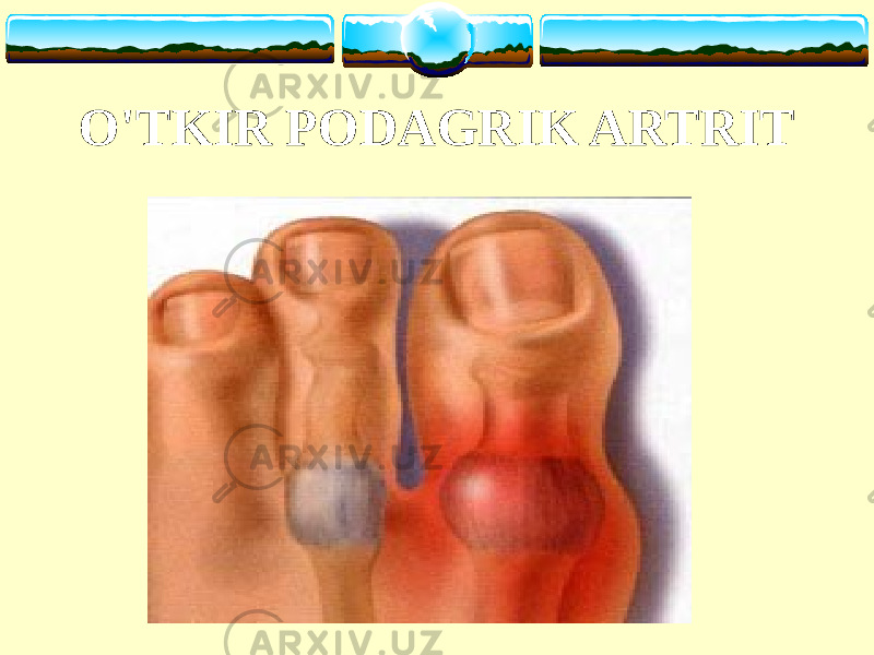 O&#39;TKIR PODAGRIK ARTRIT 