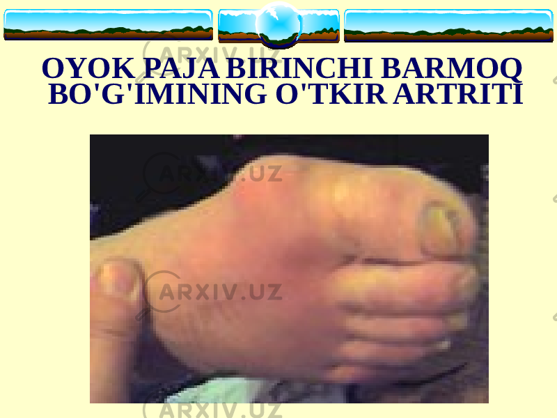 OYOK PAJA BIRINCHI BARMOQ BO&#39;G&#39;IMINING O&#39;TKIR ARTRITI 