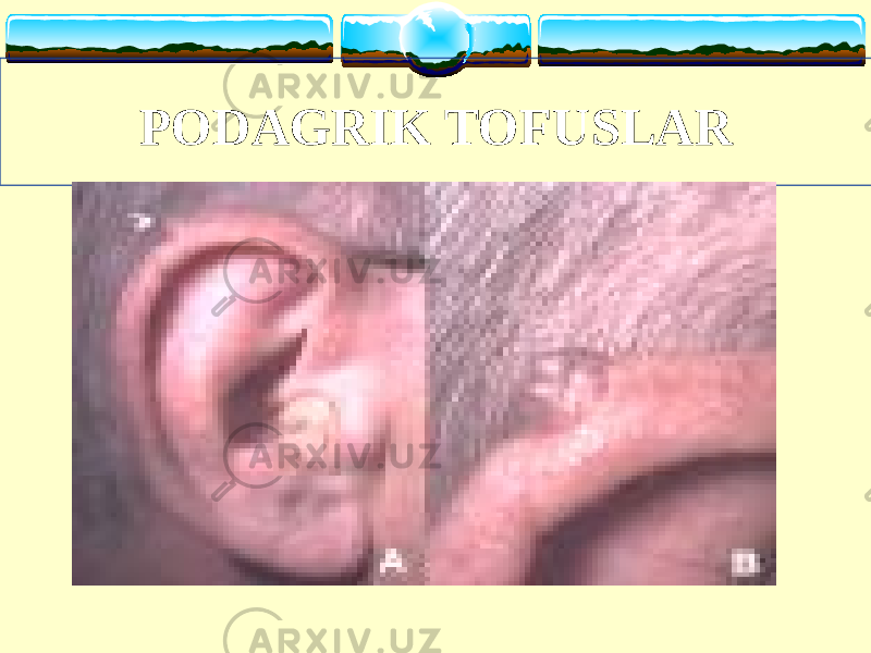 PODAGRIK TOFUSLAR                        