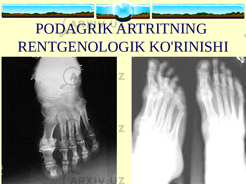 PODAGRIK ARTRITNING RENTGENOLOGIK KO&#39;RINISHI 