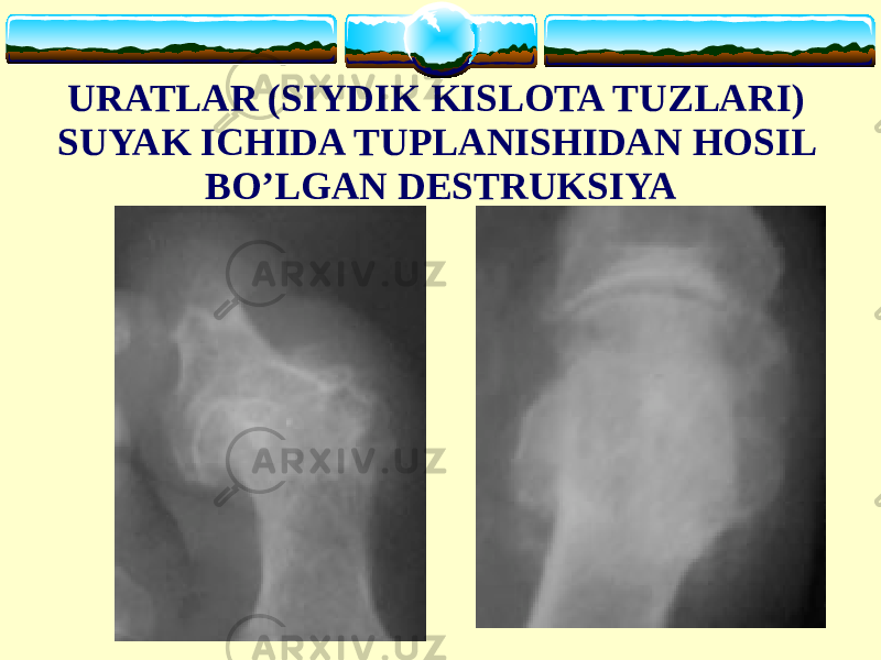 URATLAR (SIYDIK KISLOTA TUZLARI) SUYAK ICHIDA TUPLANISHIDAN HOSIL BO’LGAN DESTRUKSIYA 