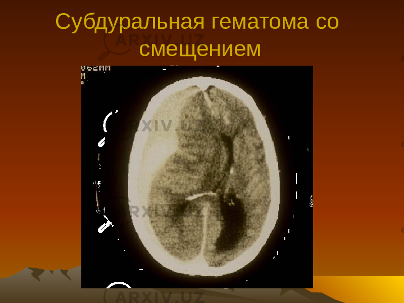 Субдуральная гематома со смещением 