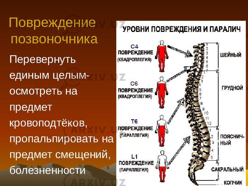 Повреждение позвоночника Перевернуть единым целым- осмотреть на предмет кровоподтёков, пропальпировать на предмет смещений, болезненности 