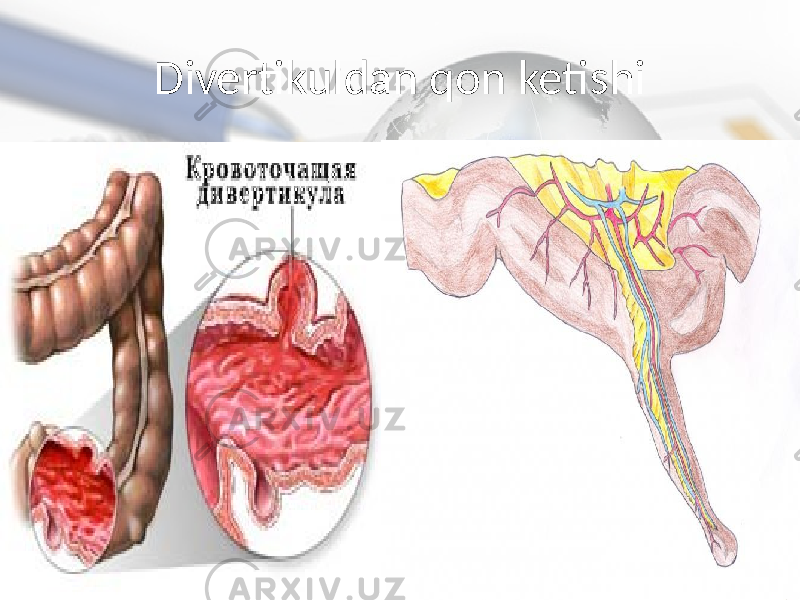 Divertikuldan qon ketishi 