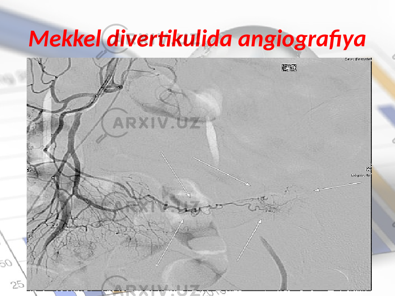 Mekkel divertikulida angiografiya 