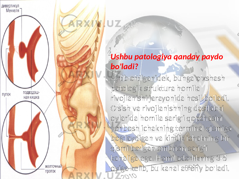 Ushbu patologiya qanday paydo bo&#39;ladi? Aytib o&#39;tilganidek, bunga o&#39;xshash patologik struktura homila rivojlanishi jarayonida hosil bo&#39;ladi. O&#39;sish va rivojlanishning dastlabki oylarida homila sarig&#39;i qopchasini yonbosh ichakning terminal qismiga bog&#39;laydigan va kindik ichakning bir qismi bo&#39;lgan embrion sarig&#39;i kanaliga ega. Homiladorlikning 3-5 oyiga kelib, bu kanal atrofiy bo&#39;ladi. 